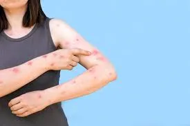 ÁFRICA DECLARA EMERGÊNCIA EM SAÚDE PÚBLICA POR EPIDEMIA DE MPOX 